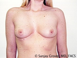 Breast Augmentation Before and After 189 | Sanjay Grover MD FACS