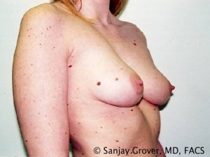 Breast Augmentation Before and After 97 | Grover Aesthetics