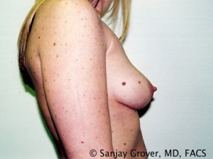 Breast Augmentation Before and After 97 | Grover Aesthetics