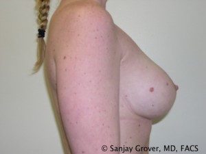 Breast Augmentation Before and After 97 | Grover Aesthetics