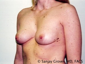 Breast Augmentation Before and After 97 | Grover Aesthetics