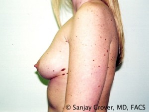 Breast Augmentation Before and After 97 | Grover Aesthetics