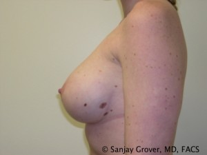 Breast Augmentation Before and After 97 | Grover Aesthetics
