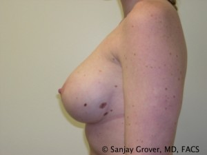 Breast Augmentation Before and After 97 | Sanjay Grover MD FACS