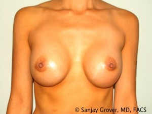 Breast Augmentation Before and After | Grover Aesthetics