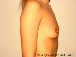 Breast Augmentation Before and After 98 | Grover Aesthetics