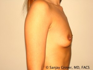 Breast Augmentation Before and After 98 | Sanjay Grover MD FACS