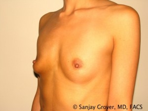 Breast Augmentation Before and After 98 | Grover Aesthetics