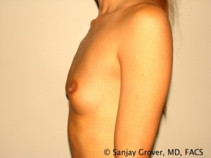 Breast Augmentation Before and After 98 | Grover Aesthetics