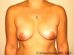 Breast Augmentation Before and After 85 | Sanjay Grover MD FACS