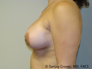 Breast Augmentation Before and After 99 | Sanjay Grover MD FACS