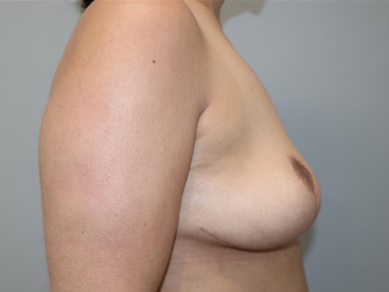 Breast Implant Removal Before and After 01 | Grover Aesthetics