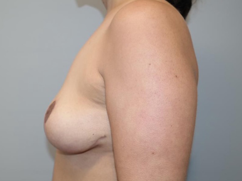 Breast Implant Removal Before and After 01 | Grover Aesthetics