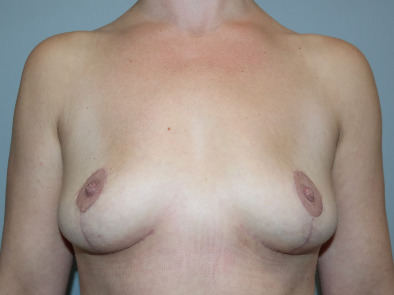 Breast Implant Removal Before and After | Grover Aesthetics