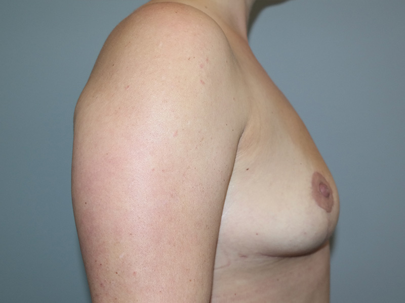 Breast Implant Removal Before and After 02 | Grover Aesthetics