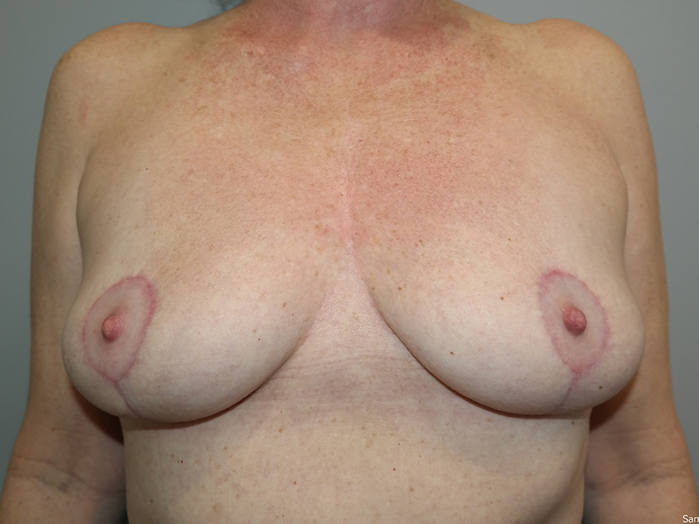 Breast Implant Removal Before and After | Sanjay Grover MD FACS