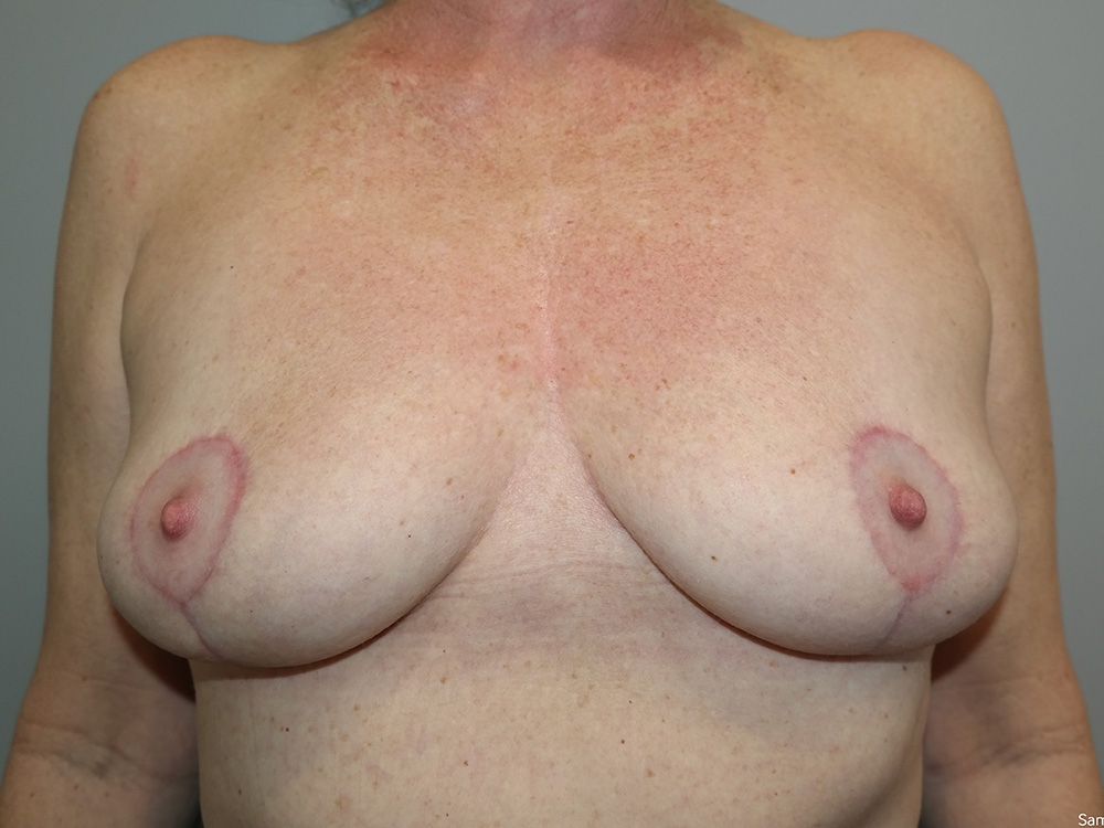 Breast Implant Removal Before and After | Grover Aesthetics