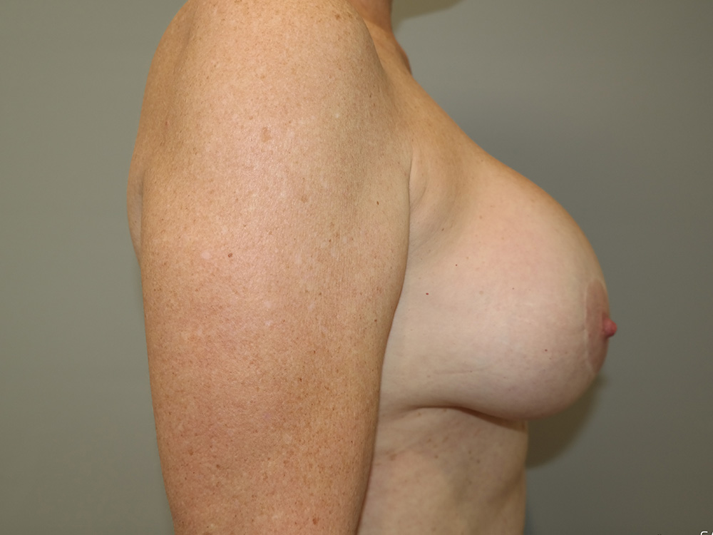 Breast Implant Removal Before and After 04 | Grover Aesthetics