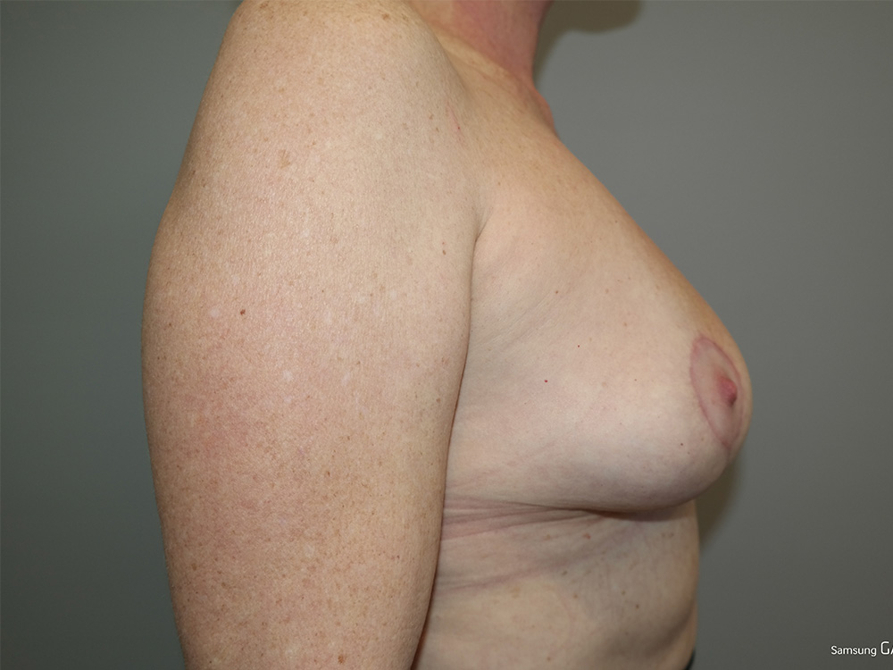Breast Implant Removal Before and After 04 | Grover Aesthetics