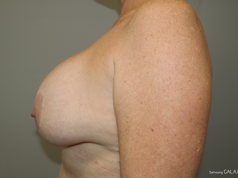 Breast Implant Removal Before and After 04 | Grover Aesthetics