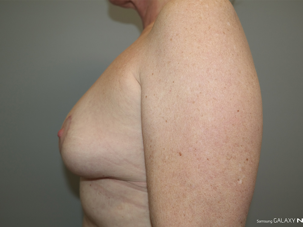 Breast Implant Removal Before and After 04 | Grover Aesthetics
