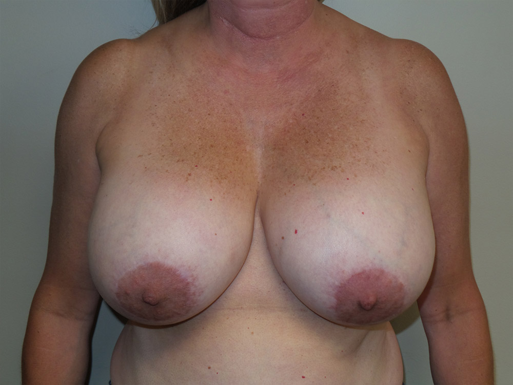 Breast Implant Removal Before and After | Grover Aesthetics