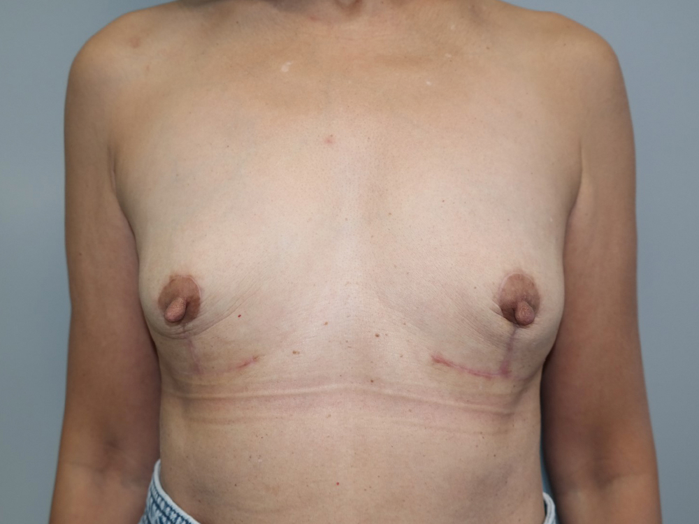 Breast Implant Removal Before and After | Grover Aesthetics