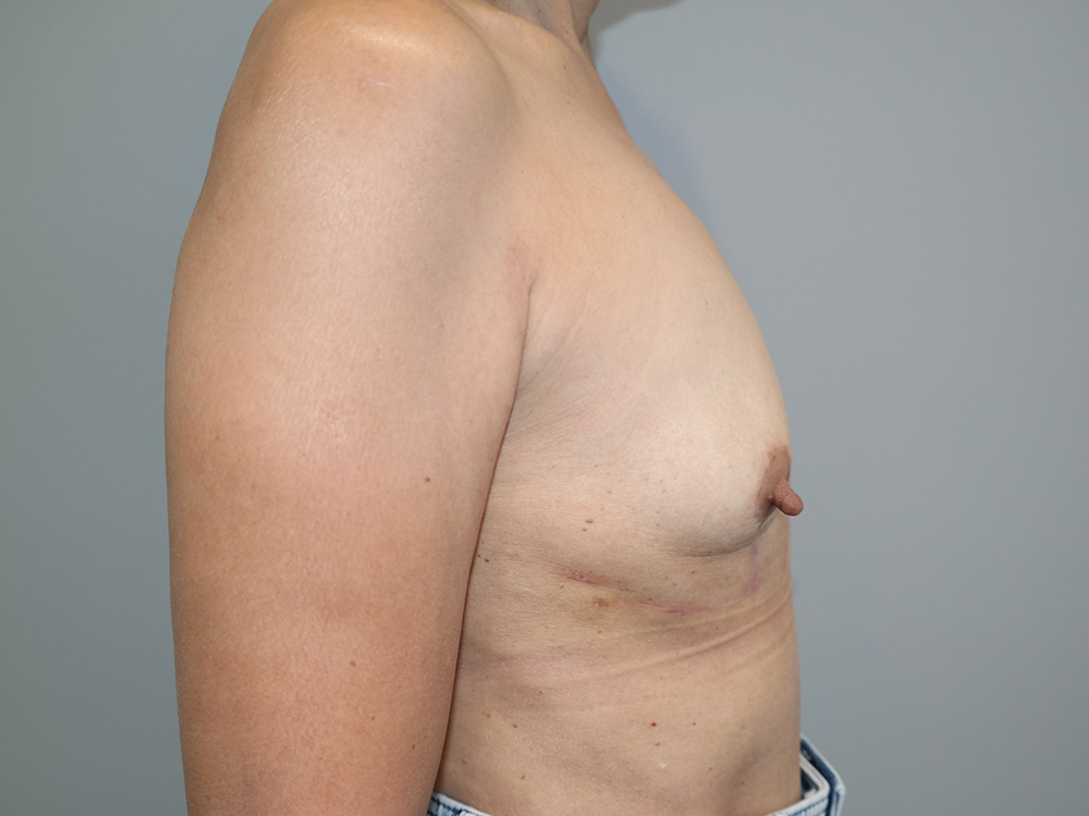 Breast Implant Removal Before and After 09 | Grover Aesthetics
