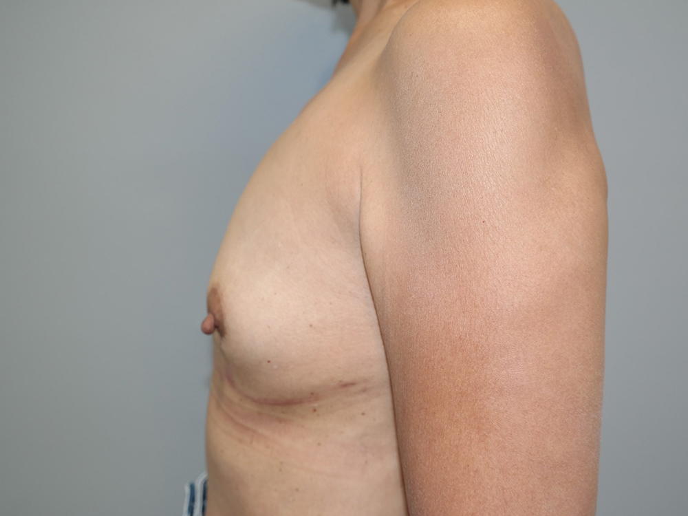 Breast Implant Removal Before and After 09 | Grover Aesthetics