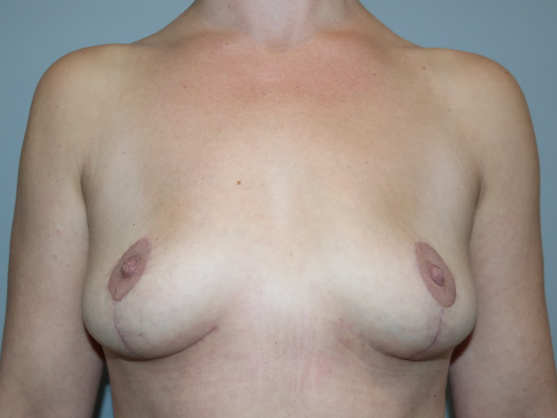Breast Lift Before and After 01 | Sanjay Grover MD FACS