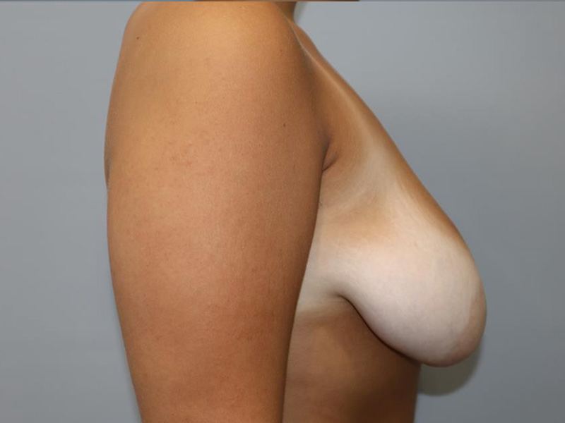 Breast Lift Before and After 01 | Sanjay Grover MD FACS