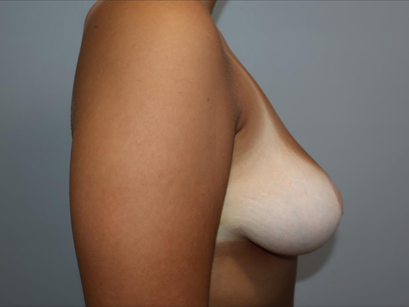 Breast Lift Before and After 01 | Sanjay Grover MD FACS