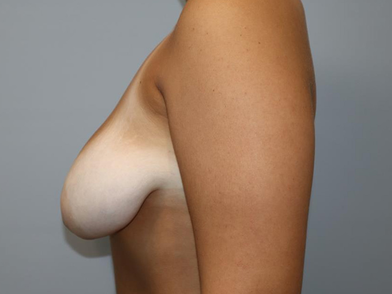 Breast Lift Before and After 01 | Sanjay Grover MD FACS