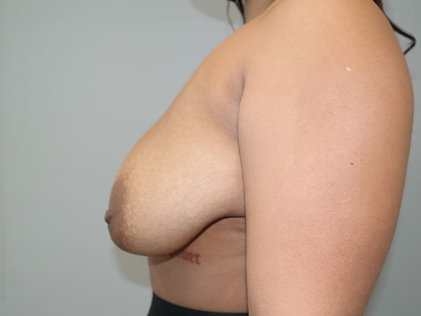 Breast Lift Before and After 07 | Sanjay Grover MD FACS