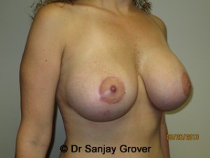 Breast Lift Before and After 08 | Sanjay Grover MD FACS