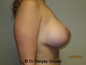 Breast Lift Before and After 08 | Sanjay Grover MD FACS
