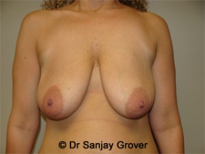 Breast Lift Before and After 39 | Sanjay Grover MD FACS