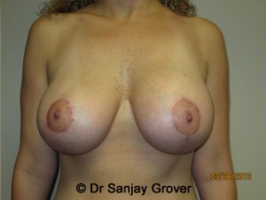 Breast Lift Before and After | Sanjay Grover MD FACS