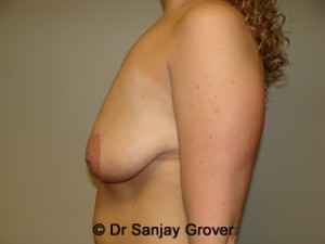 Breast Lift Before and After 11 | Grover Aesthetics