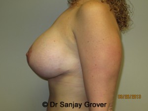 Breast Lift Before and After 11 | Grover Aesthetics