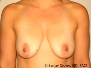 Breast Lift Before and After 05 | Sanjay Grover MD FACS