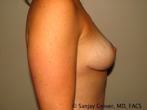 Breast Lift Before and After 13 | Grover Aesthetics