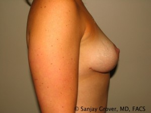 Breast Lift Before and After 13 | Sanjay Grover MD FACS