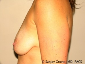 Breast Lift Before and After 13 | Grover Aesthetics