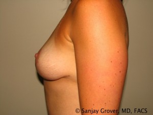 Breast Lift Before and After 13 | Grover Aesthetics