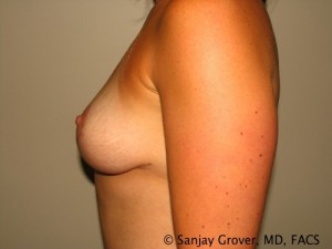 Breast Lift Before and After 13 | Sanjay Grover MD FACS