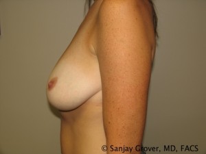 Breast Lift Before and After 16 | Sanjay Grover MD FACS