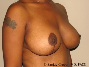 Breast Lift Before and After 19 | Sanjay Grover MD FACS