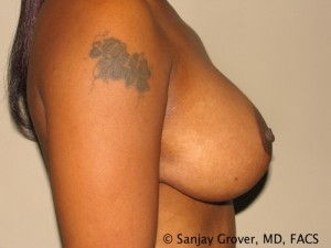 Breast Lift Before and After 19 | Grover Aesthetics