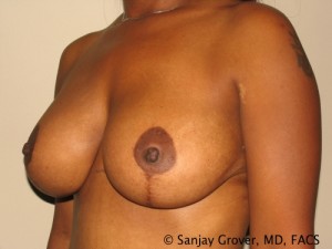 Breast Lift Before and After 19 | Grover Aesthetics